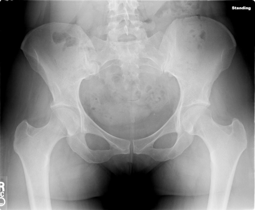 Not all people have the same type of hip anatomy. There is natural variation in both the shape and orientation of the femoral head and neck and in the shape and orientation of the acetabulum.