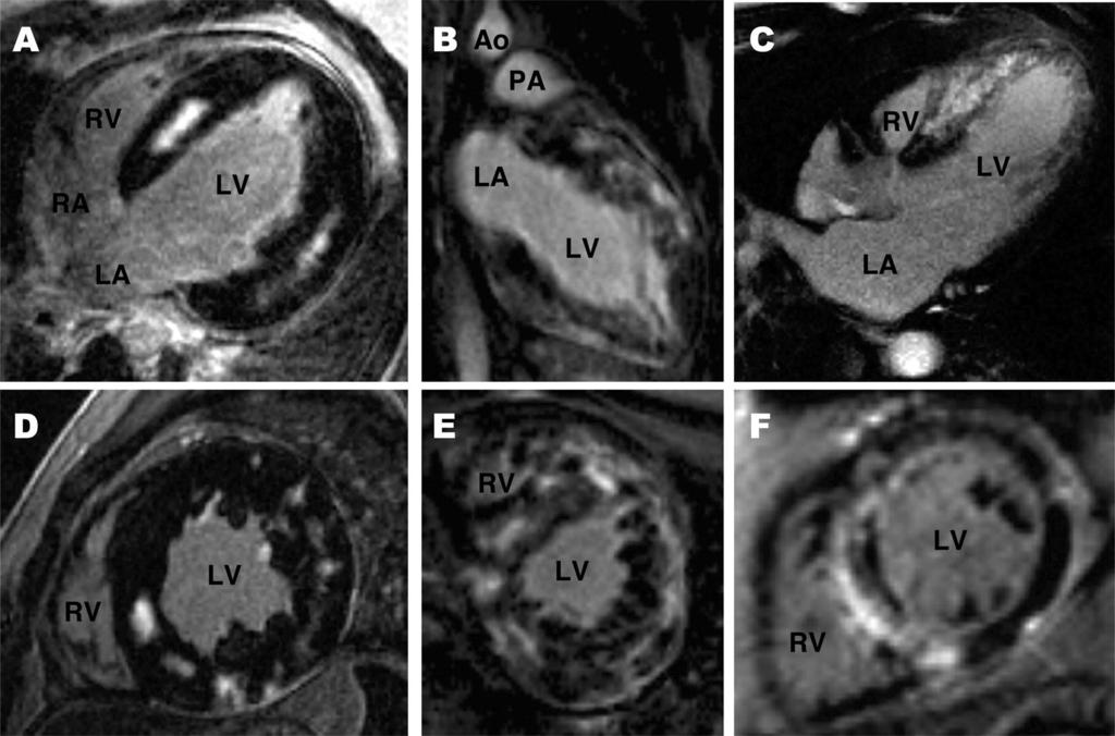 CARDIAC MRI GADOLINIUM Delayed enhanced CMR horizontal long-axis (A, B, and C) and short-axis (D, E, and F)