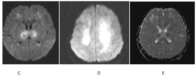 MRI showed TI- hypointensity, T2,FLAIR hyperintensity with diffusion restriction and hemorrhagic foci in affected areas of brain. CT showed hypodensity in affected regions of brain.