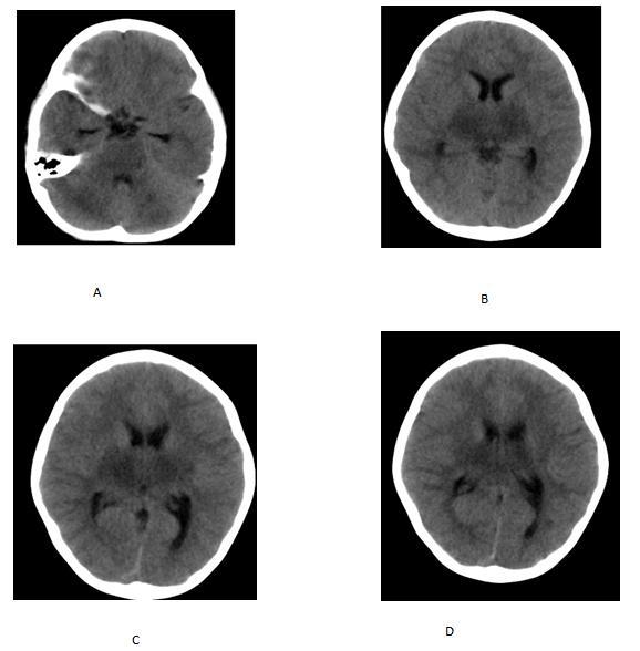 CASE 2: Figure 2: 5year female child with dengue encephalitis.