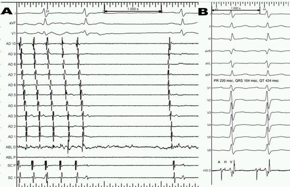 After ablation of the right bundle branch no induction of the clinical tachycardia or other arrhythmias were possible. The HV interval then was 92 msec, so definitive cardiac pacing was not required.