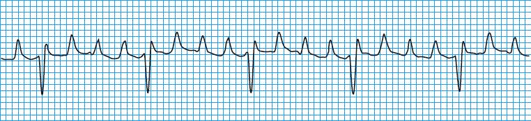 250-350 beats/min Ventricular rate typically