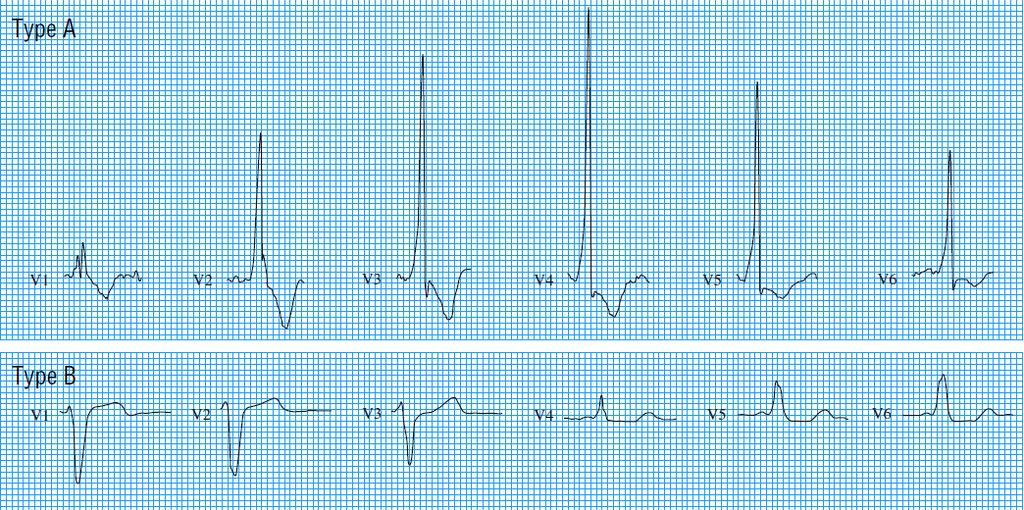 Wolff Parkinson White syndrome Type A,B: delta wave/qrs complex over precordial leads