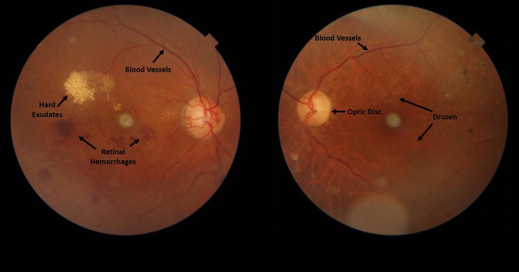 Figure 1: Abnormal pathological symptoms on fundus images reflecting different types of retinal syndromes Figure 2 shows a randomly selected OCT B-scans from the proposed dataset that depicts the