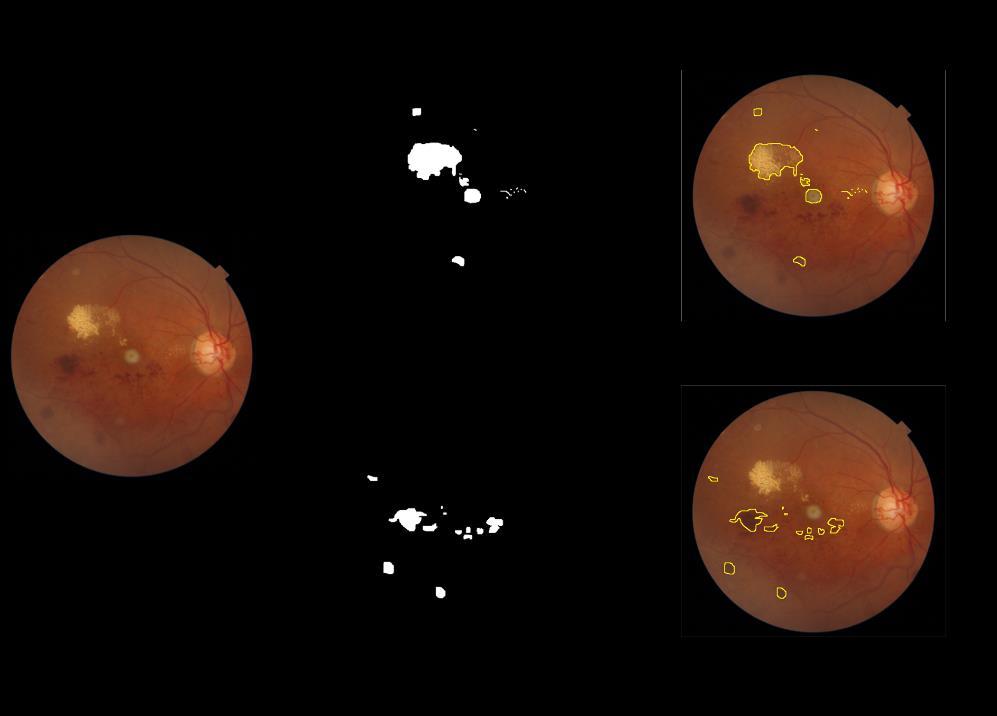 Figure 4: A fundus scan containing exudates and retinal hemorrhages.