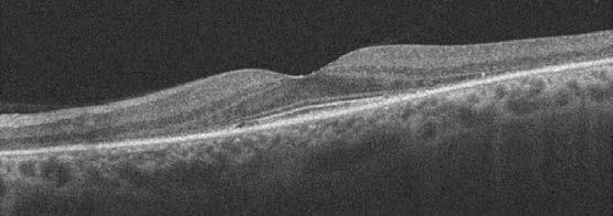 Macular OCT shows extrafoveal loss of the RPE