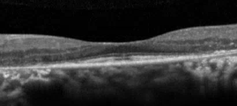 Macular OCT shows extrafoveal loss of the RPE and