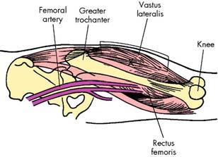 Thigh muscles Proper place of injection: place 1 hand on upper thigh and 1 hand on lower thigh Area between 2 hands on anterior surface of thigh vastus lateralis In adults, up to 5 ml can be injected