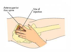 trochanter Thumb toward umbilicus Index finger on anterior iliac spine tubercle Middle finger on