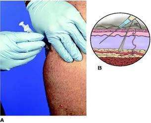 Administration of subcutaneous injections Subcutaneous (Sub-Q) space Small syringes and needles are used Site of injection: Upper arms Upper back Scapular region Self-administration: usually abdomen