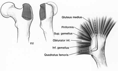 550 J. SANCHEZ-SOTELO, J. GIPPLE, D. BERRY, C. ROWLAND, R. COFIELD a Fig. 1. a) The positioning of the posterior trochanteric osteotomy with its relationship to the surrounding muscles.