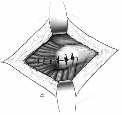 The superior and inferior portions of the hip capsule are divided as necessary.