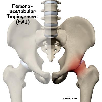 round head of the femur isn't as round as it should be. It's more of a pistol grip shape. It's even referred to as a pistol grip or tilt deformity.