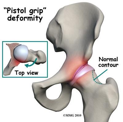 They differ slightly depending on what gets pinched and where the impingement occurs.