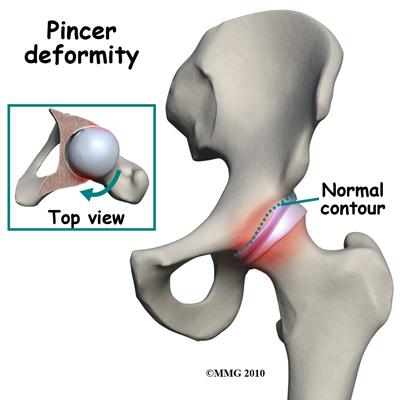 Sometimes cam-type impingement occurs as a result of some other hip problem (e.g., Legg- Calvé-Perthes disease, slipped capital femoral epiphysis or SCFE).