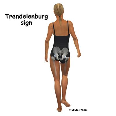 also reproduces the pain. Some patients have a positive Trendelenburg sign (hip drops down on the right side when standing on the left leg and vice versa).