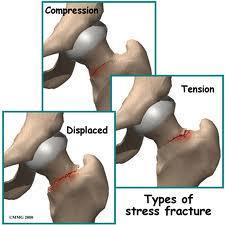 Stress fractures at the pelvis Femoral neck stress fracture: 1. Symptoms: Groin pain.
