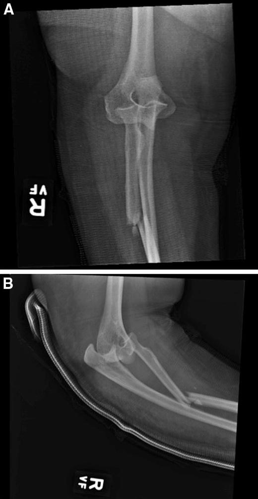 64 J Orthopaed Traumatol (2014) 15:63 67 ROM of the right wrist with laxity to DRUJ shuck as compared to the contralateral limb.