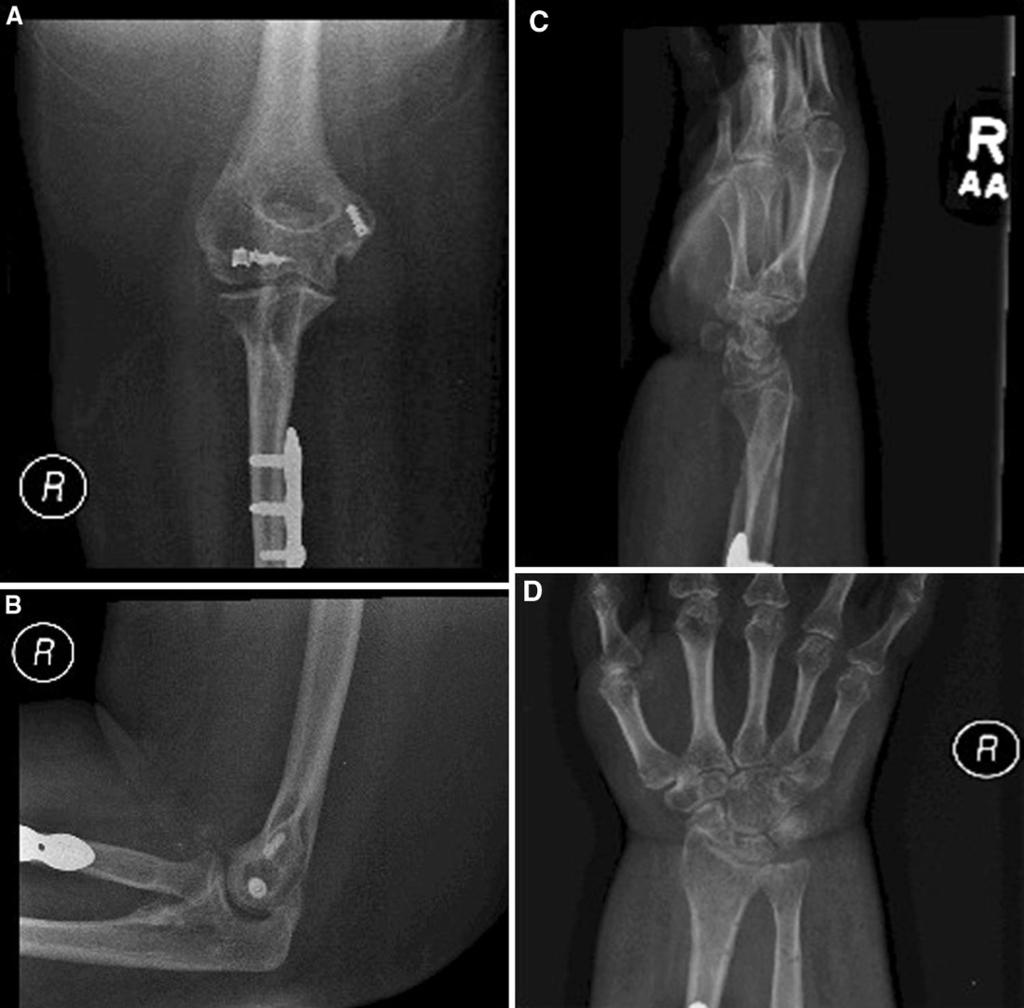 J Orthopaed Traumatol (2014) 15:63 67 65 when extended to less than 40. To supplement the repair for 6 weeks, a unilateral hinged external fixator was placed.