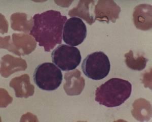 Peripheral blood smear: CLL laboratory features CLL is a
