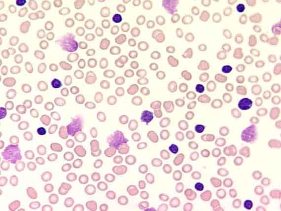 accumulation of small, mature, long-living lymphocytes in