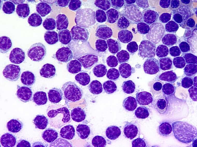 Bone Marrow smear (cytological examination) extensive replacement of