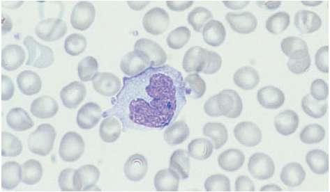 Monocytosis Reactive Chronic Infectious/ Inflammatory/ Granulomatous Metastatic Cancer Lymphoma Follow AMI Relative