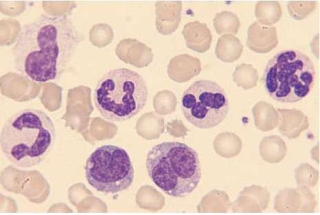 Simple Approach to Abnormal FBC results High White Blood Counts Causes: 1.