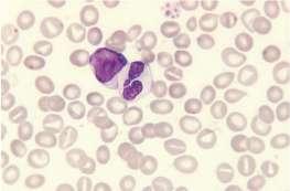 Important Questions for Leucocytosis : Is this Reactive? Is this Neoplastic (Clonal)?
