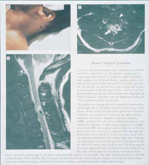 A 21 year old man presented with a stab wound of the right side of the neck (Panel A).
