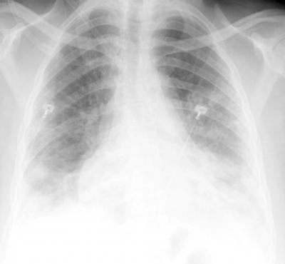 Figure 3 Figure 3: CT scan of the chest showing bilateral peripheral patchy consolidations and ground-glass opacities in nitrofurantoin-associated pulmonary toxicity.