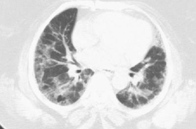 Figure 2 Figure 2: Chest radiograph showing bilateral lower lobe infiltrates in a patient with nitrofurantoin-associated pulmonary toxicity.