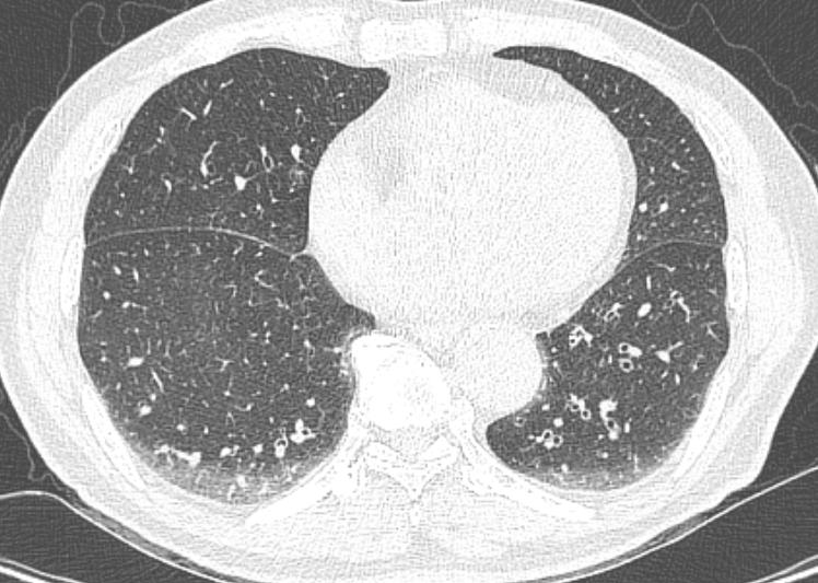 Ground Glass Opacity Homogeneous ground glass opacity in the basal dependent lungs.