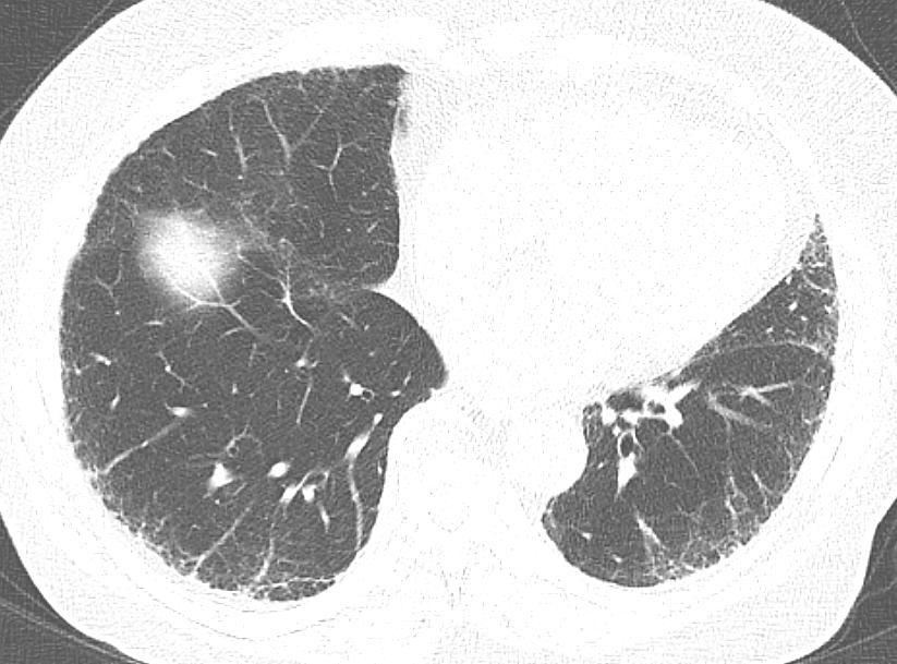 72/M 76/F Subtle reticular densities in both lower subpleural lungs on CT in