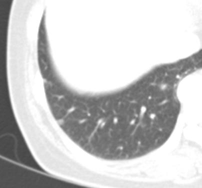 Intrapulmonary lymph nodes A common cause of incidental small pulmonary