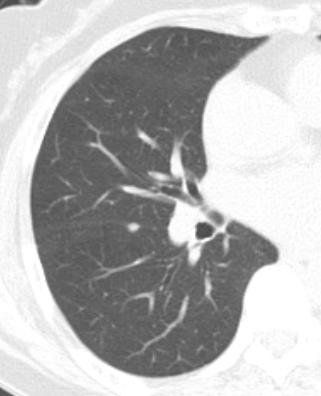 follow-up required Radiology 2010;154:949 66/F 76/M Small ovoid nodules in interlobar fissures (arrows) on