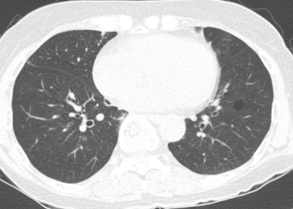 RML and LLL (arrows) on CT.