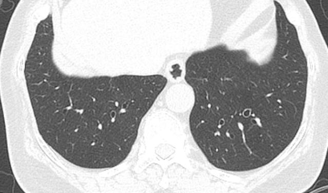 Increased bronchoarterial ratio and bronchial wall thickness Increased CT bronchoarterial ratio and bronchial wall thickness with age Relative