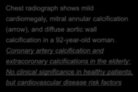 regurgitation in 90% of healthy patients over 80 years of age Chest radiograph shows mild cardiomegaly, mitral annular calcification (arrow), and diffuse aortic wall calcification