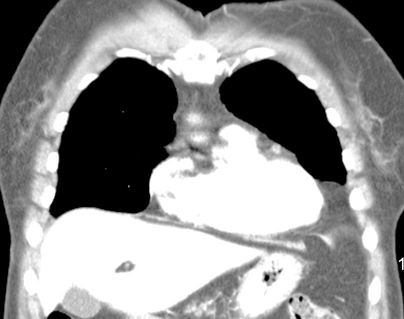 angle area which is classic appearance of prominent paracardaic fat pad. This is confirmed on CT.