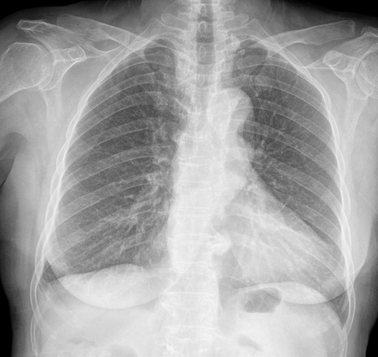 Chest PA radiograph in a 75-year-old