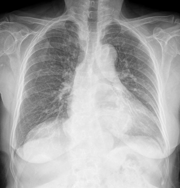 Chest PA radiograph in an 80-year-old