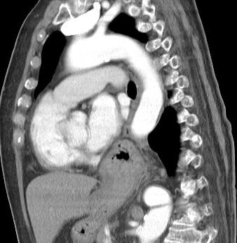 Chest CT confirms esophageal hiatal