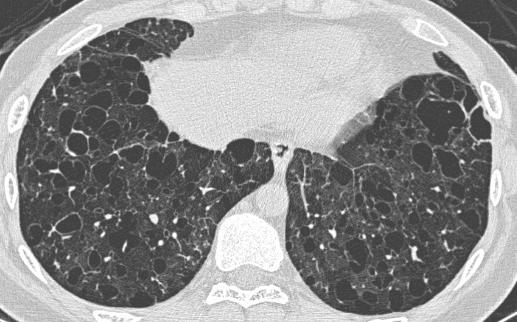 Case 7: Question 7.2 What is the diagnosis? 1. Emphysema 2.