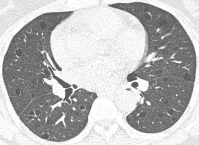 Case 9: Question 9.1 What is the diagnosis? 1. Emphysema 2.