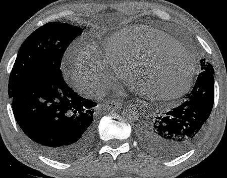 Case 10: Question 10.2 What is the associated finding? 1. Pleural effusion 2.