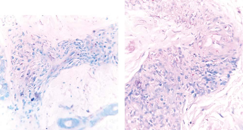 304 R. Jssi et l. Figure 4. 40X Fite Frco stined section of the skin iopsy showing mycocterium lepre. Wde-fite stin ws strongly positive (Figures 4, 4).