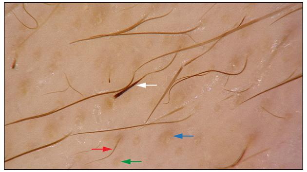 214 Wa skiel-burnat et al. Objective The assessment of the trichoscopic features of eyebrow loss in alopecia areata and frontal fibrosing alopecia.