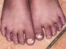 Case 4 White Toenails A 10-year-old boy presents with whitish discolouration of the toenails. His father has the same problem. a. Onychomycosis b. Nail dystrophy c. Psoriasis d.