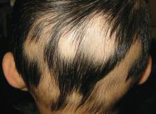 Case 6 Patches of Hair A three-year-old boy presents with multiple round patches of complete hair loss on his scalp. The scalp skin is normal and there is no family history of hair loss. a. Trichotillomania b.